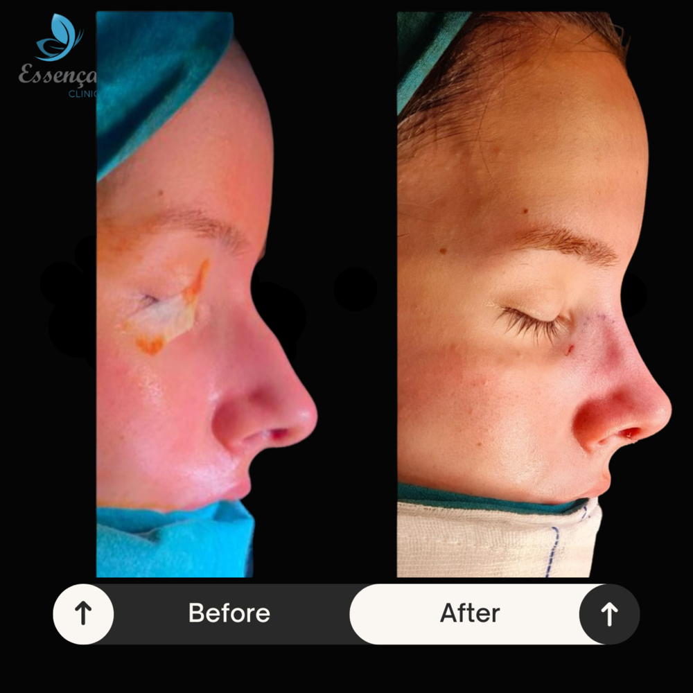 Before and After Result